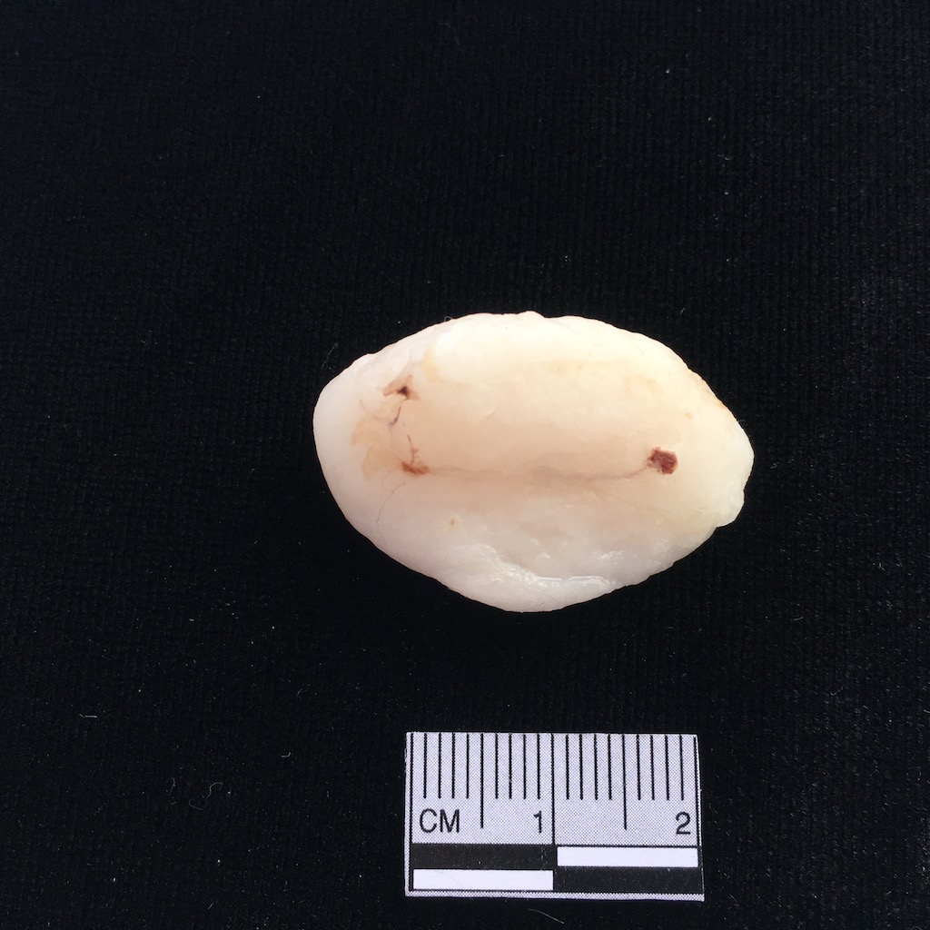 Excised Lipoma 1 2.jpg