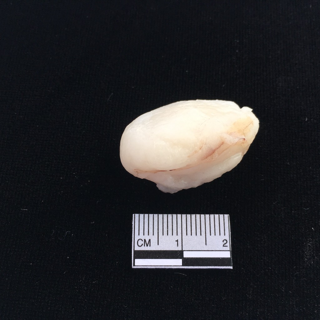 Excised Lipoma 2 2.jpg