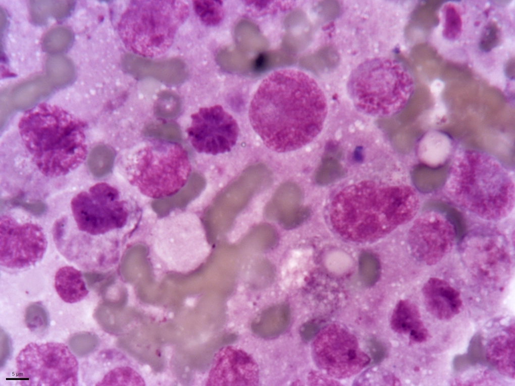 3b Histiocytic Lymphosarcoma (DMap; 2 stack; 10um).jpg
