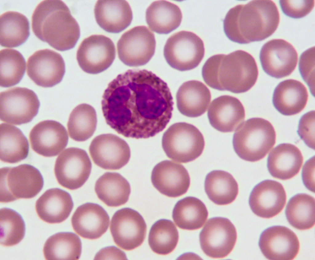 Eosinophil my own blood smear