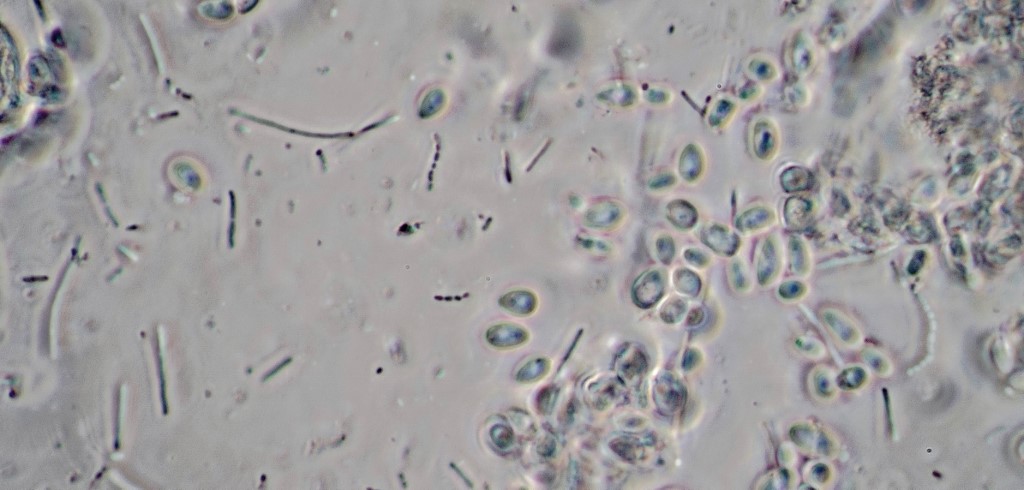 A few examples of Leuconostoc Mesenteroides( the little necklace looking colonies) and possible some Lactobacillus Brevis. Most of the biomass is undesirable yeasts and spoilage bacteria. 100X B-Minus M phase achromat. 180 um across field