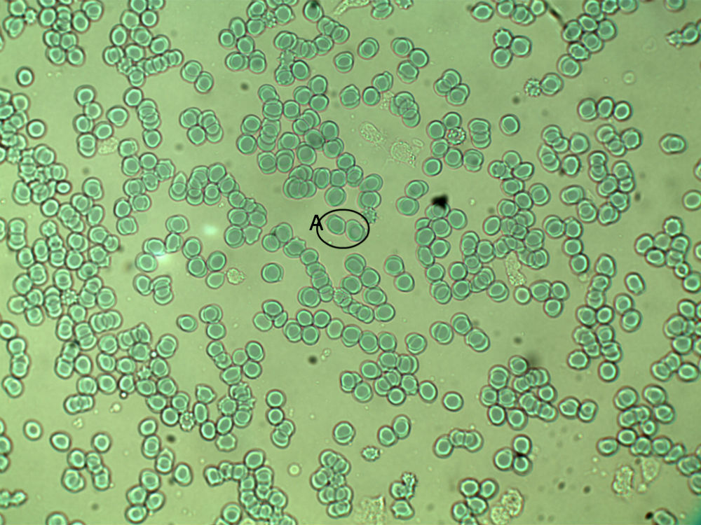 Why are these blood cells freely floating (non-sticky) while others from the same slide are heavily stacked?